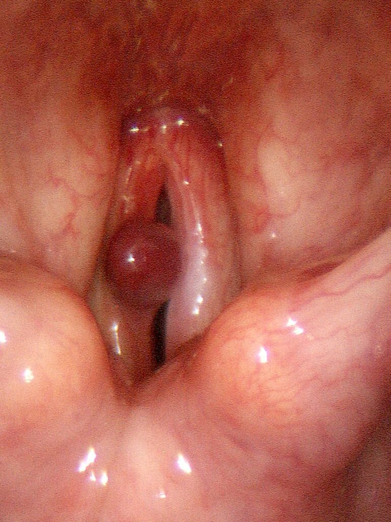 Hemorrhagic polyp adding mass to left vocal cord