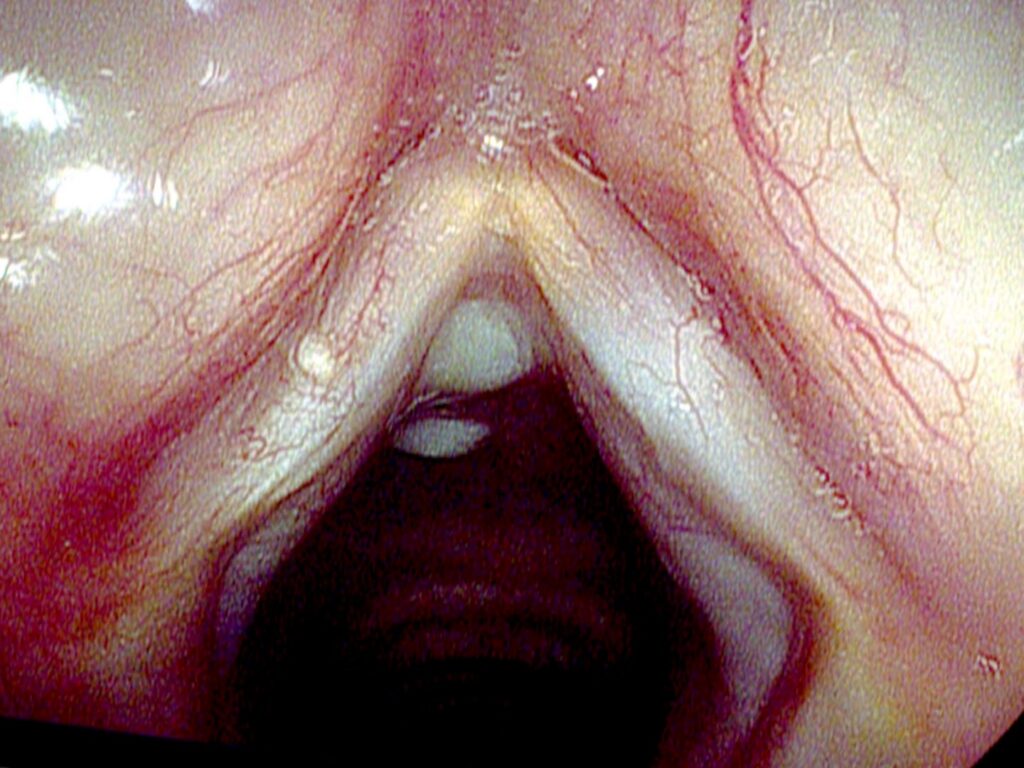 Stripped left vocal cord — stiff while right cord remains supple