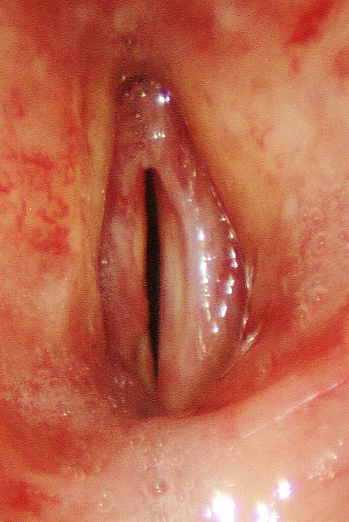 Post-radiation stiffness — slight mucosal wave on left, supple right