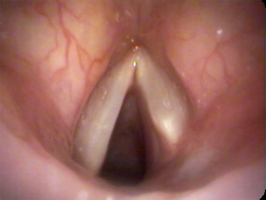 Asymmetric length — left vocal cord longer than right