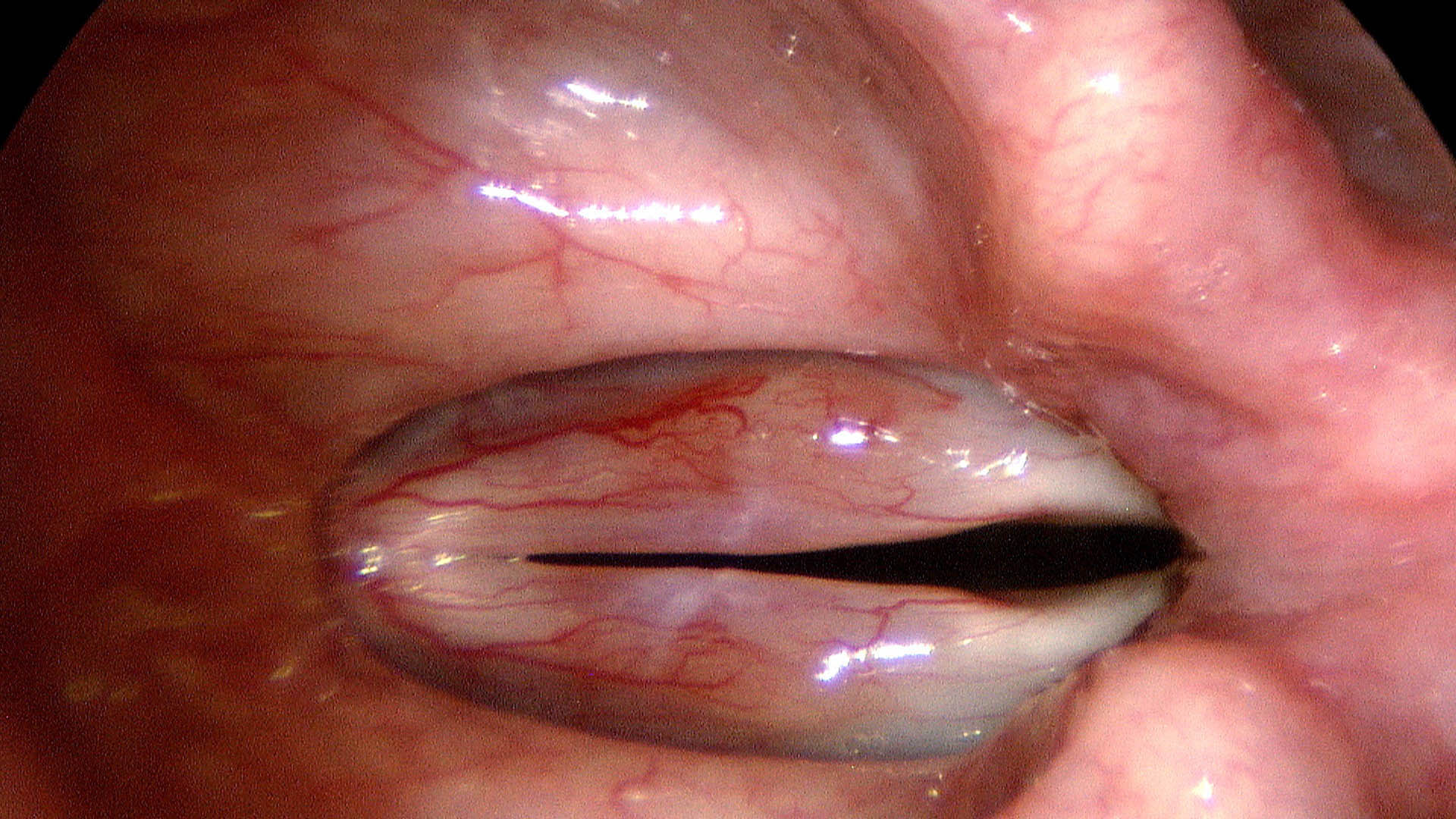 Bilateral smoker's polyps resting on the superior surface of the vocal cords with dilated ectatic vessels
