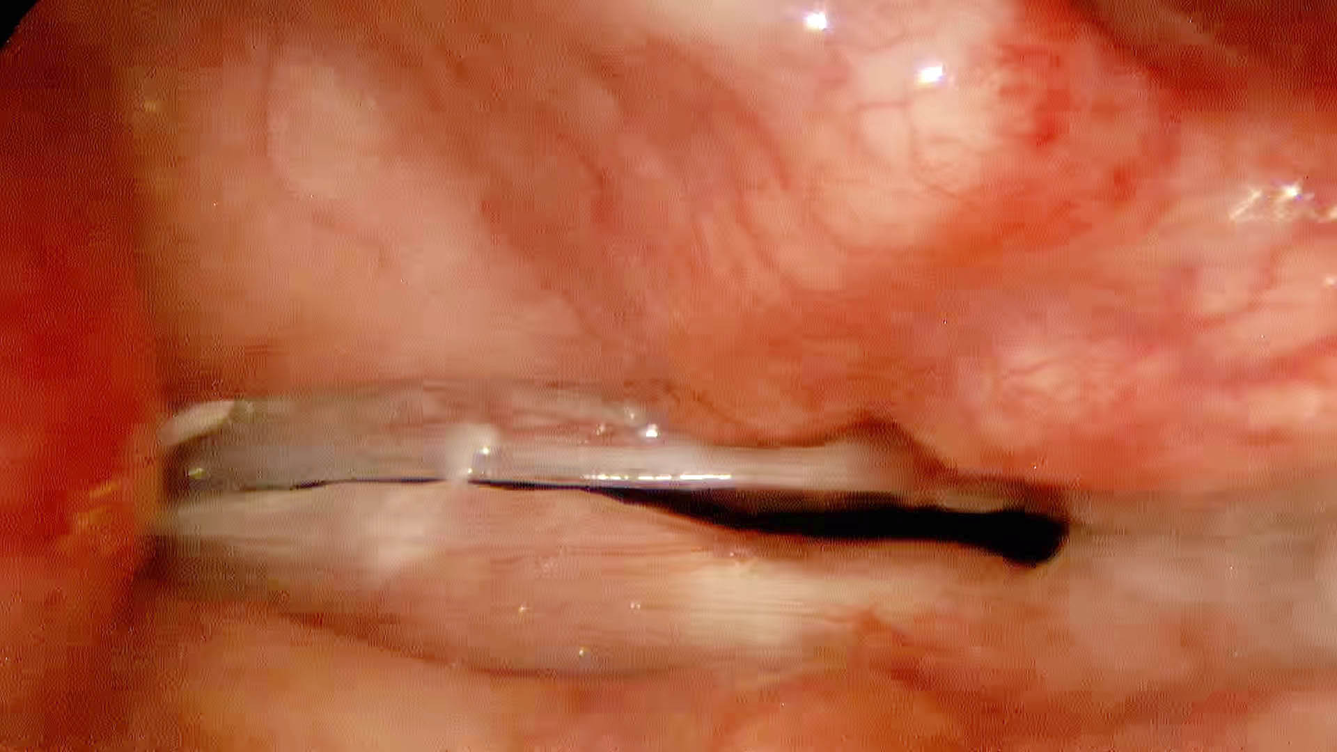 Smoker's polyps — stroboscopy view, 35-year-old patient with 7 years of raspy voice