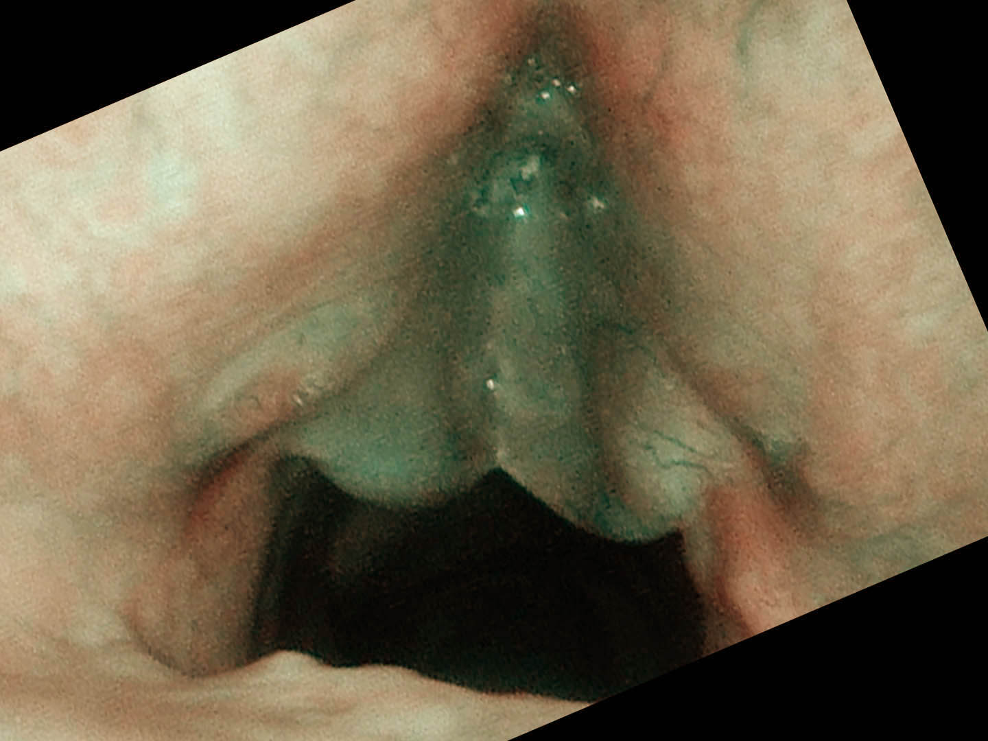 Smoker's polyps — patient with low pitch voice for many years, now losing his voice