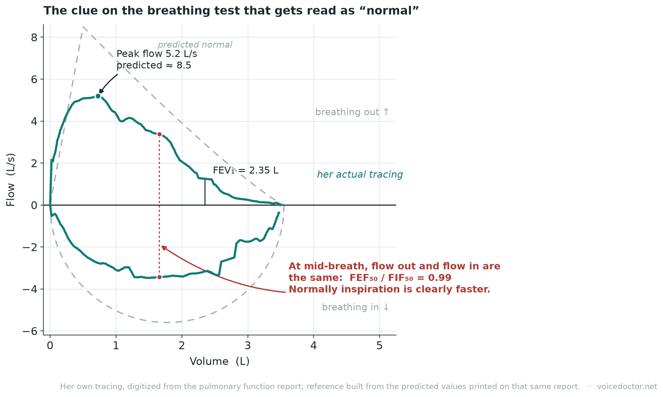 Annotated flow-volume loop digitized from the patient's pulmonary function report