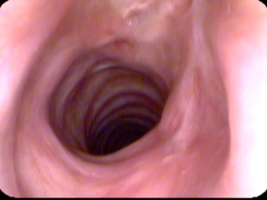 The same airway about five months after treatment