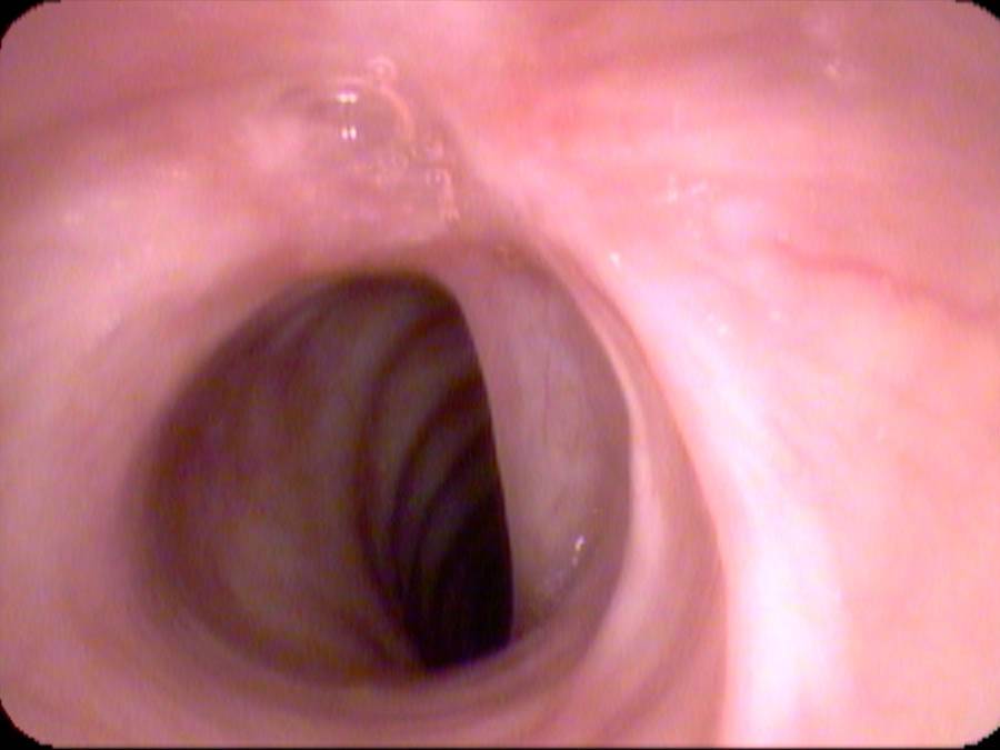 Subglottic airway at presentation, before treatment