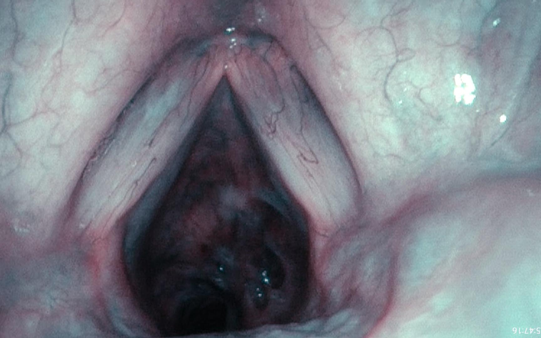 Vocal cords with subglottic hypervascularity below and to the right