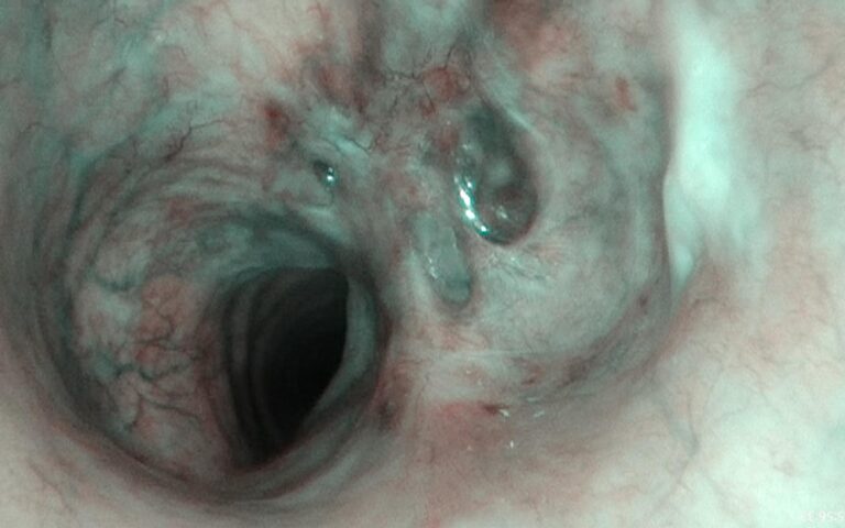 Subglottic stenosis at the junction of the cricoid and trachea